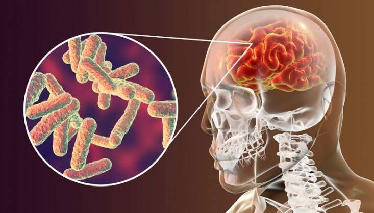 Caso de meningite bacteriana é confirmado em criança em São Borja; aulas seguem mantidas