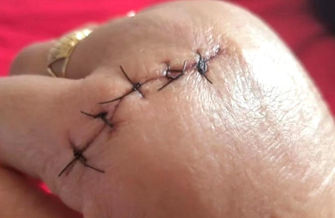 Aluna de 14 anos agride professora com faca e escola suspende aulas em Caseiros (RS)