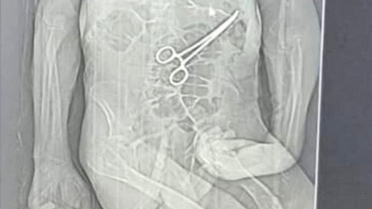 Homem de 68 anos morre após cirurgia; família acusa hospital de esquecer pinça no corpo