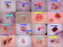 Aluna da Unipampa cria modelo de IA para auxiliar diagnóstico de câncer de pele