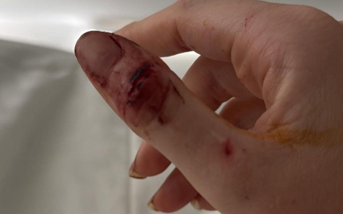 Modelo gaúcha divulga imagens de agressões e hematomas atribuídos ao ex-namorado Dado Dolabella