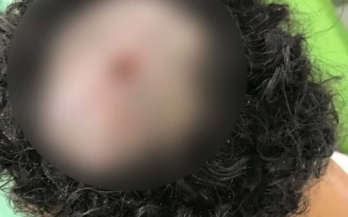 Caso aterrorizante em Santo Tomé: menina sofre perfuração no crânio causada por infestação de larvas