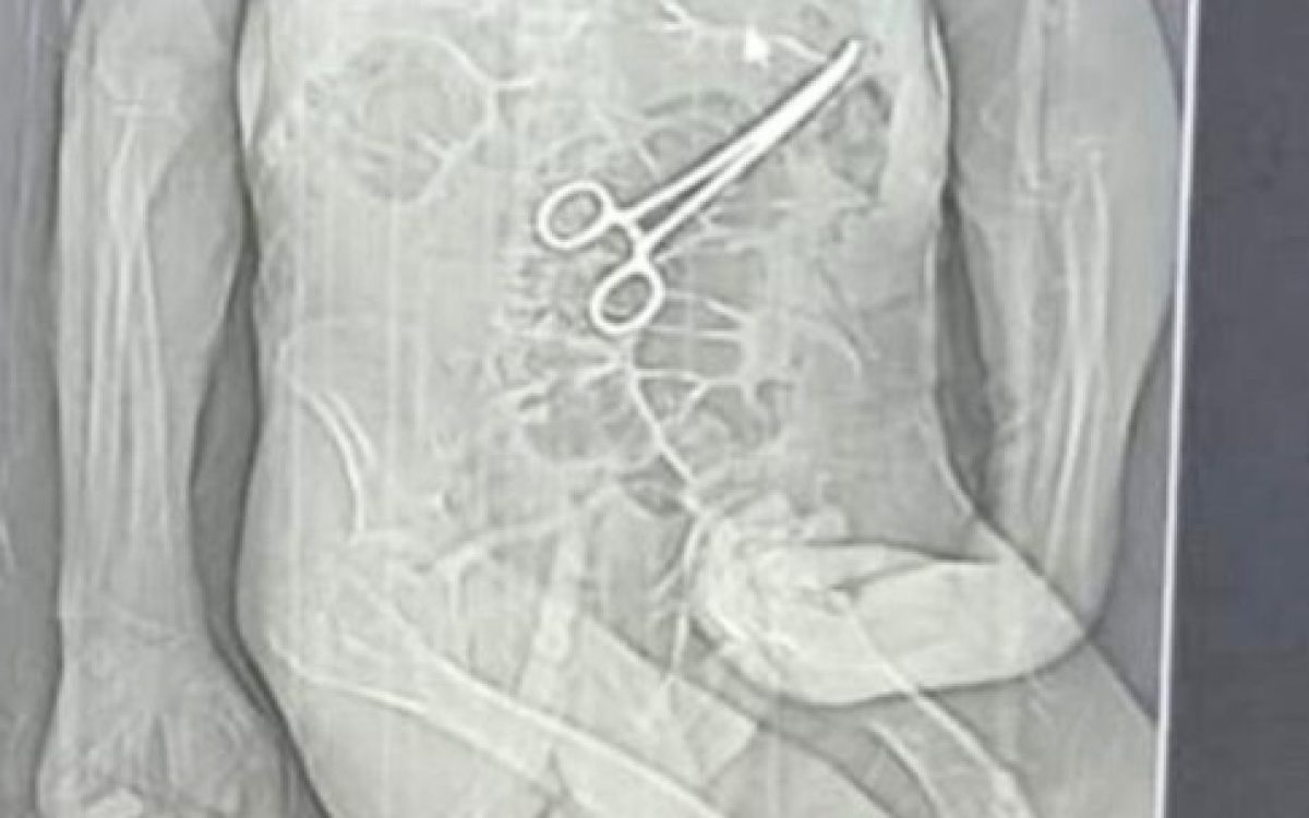 Homem de 68 anos morre após cirurgia; família acusa hospital de esquecer pinça no corpo