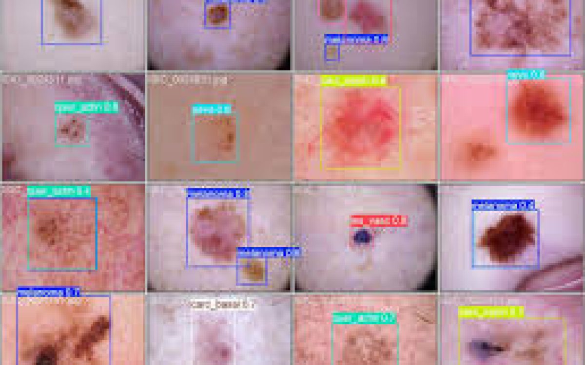 Aluna da Unipampa cria modelo de IA para auxiliar diagnóstico de câncer de pele