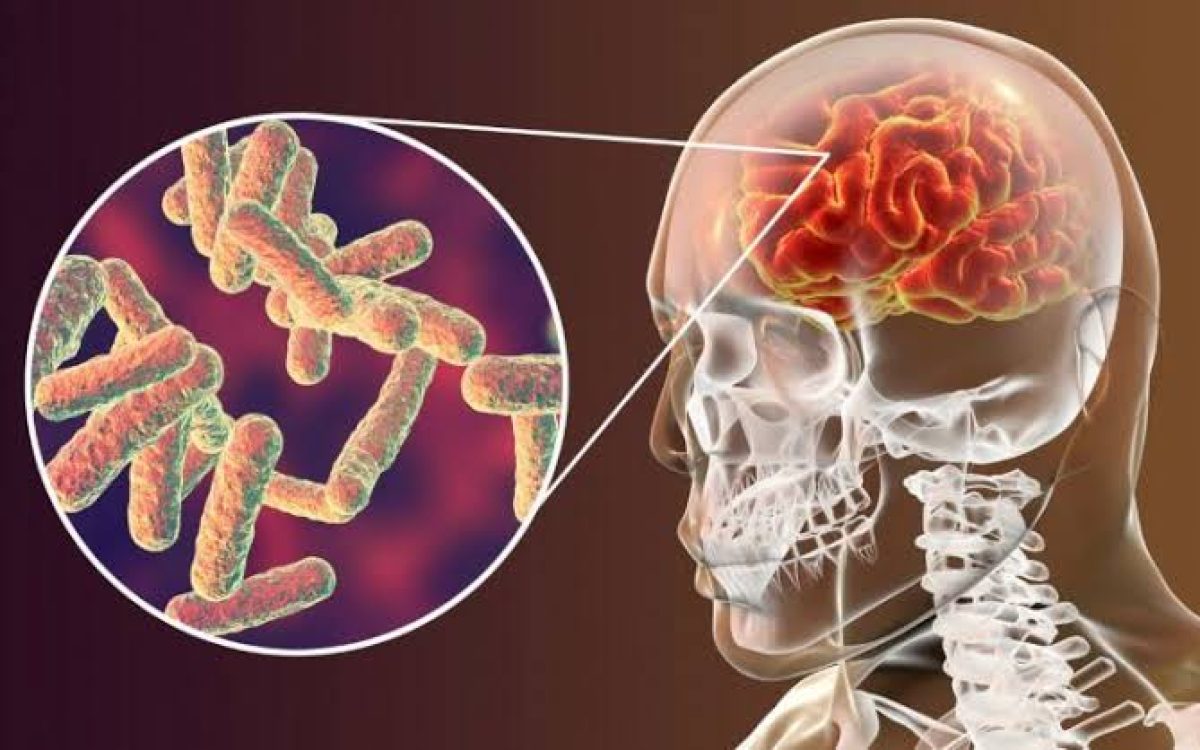 Caso de meningite bacteriana é confirmado em criança em São Borja; aulas seguem mantidas